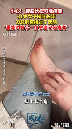 “小心！”31岁女子只因脚底长黑痣，竟被医生拉进手术室！不料，病友的一句话却让她