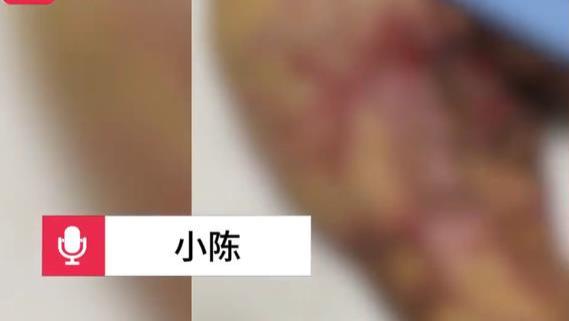 女子被前男友泼汽油，全身69%烧伤，生活难自理，本是家中顶梁柱