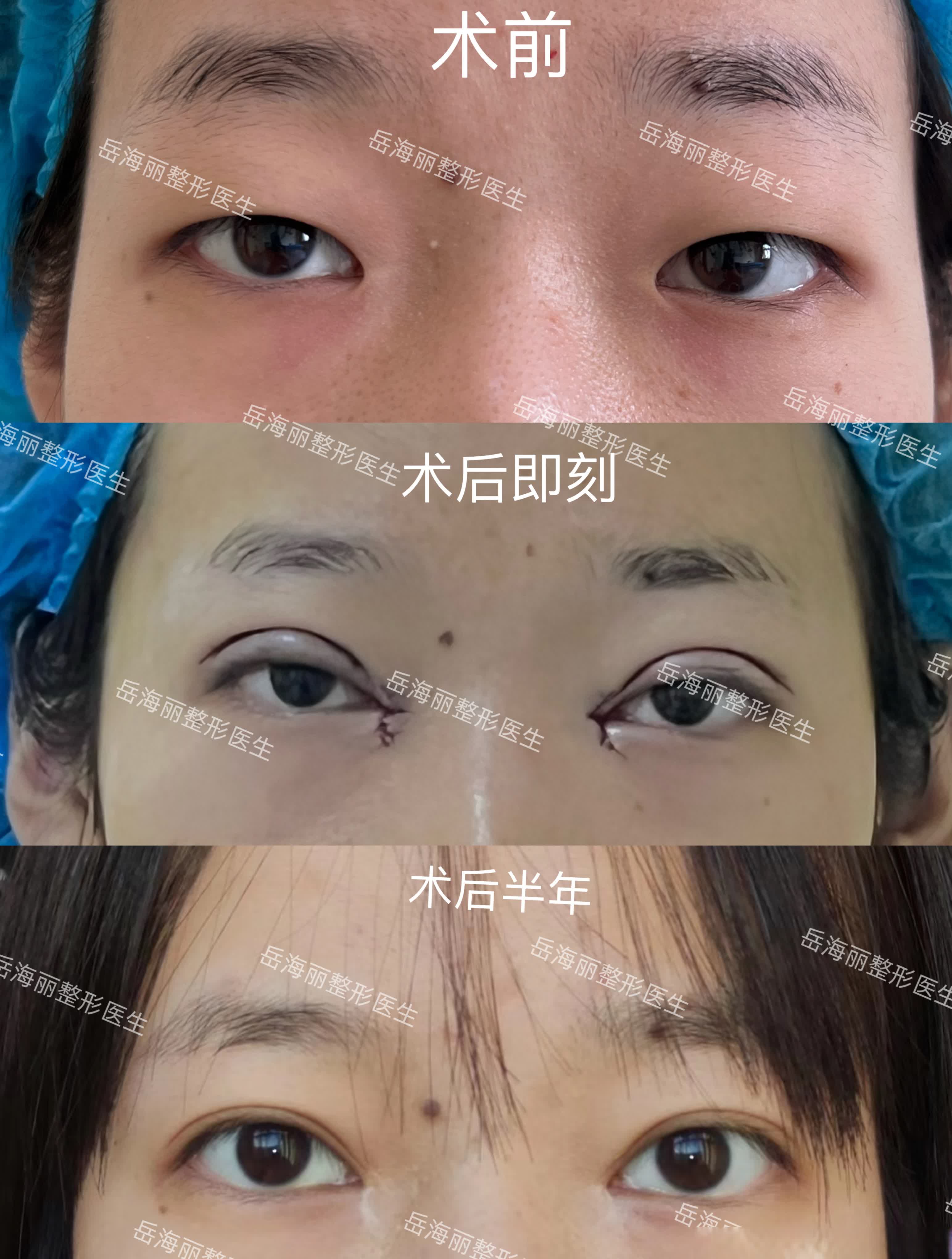 【✨只是做了个双眼皮，效果惊呆小姐姐本人！术后3次反馈实录】

📍术前痛点