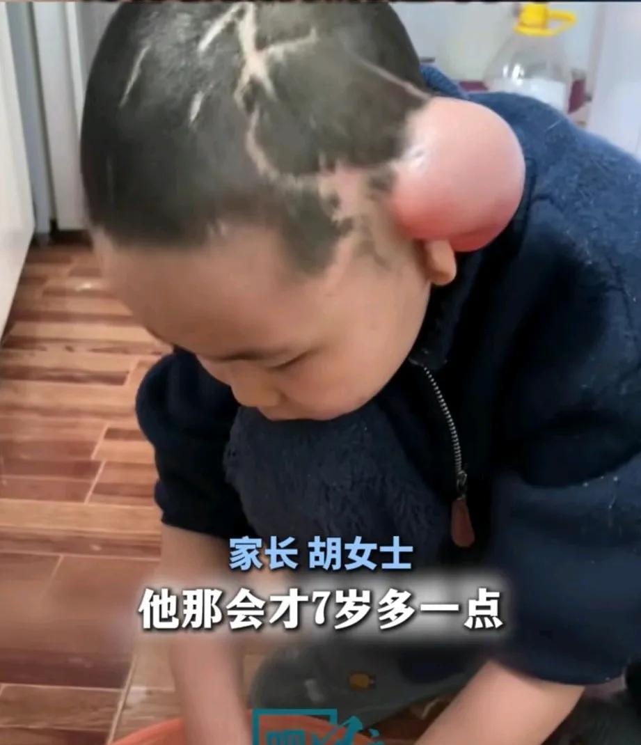七岁男孩放学途中，遭到三只大型犬的撕咬，面部、头部伤痕累累，一侧耳朵被咬的只剩一