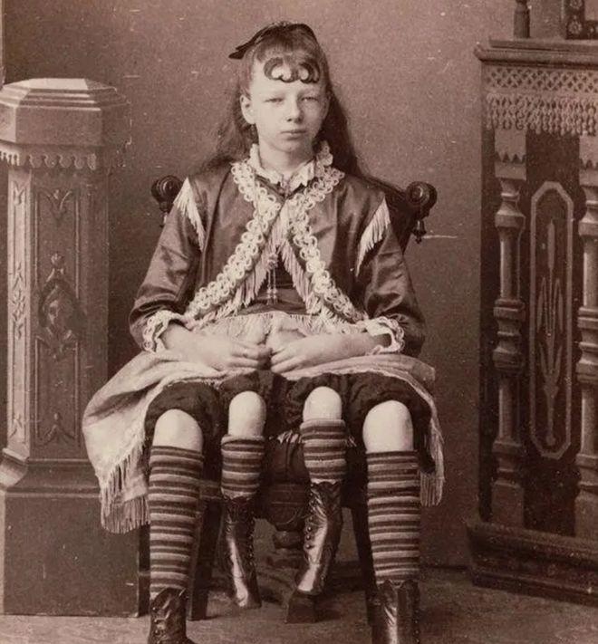 上世纪60年代，美国一个长着四条腿和两个生殖器官的女孩，被父亲高价卖给马戏团，女