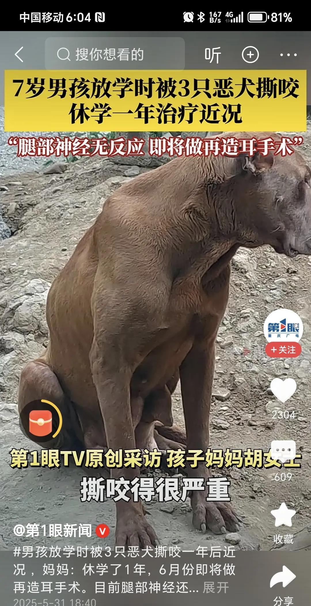 7岁男孩放学被3只恶狗撕咬，休学一年治疗，腿部神经无反应，即将做再造耳手术。
消