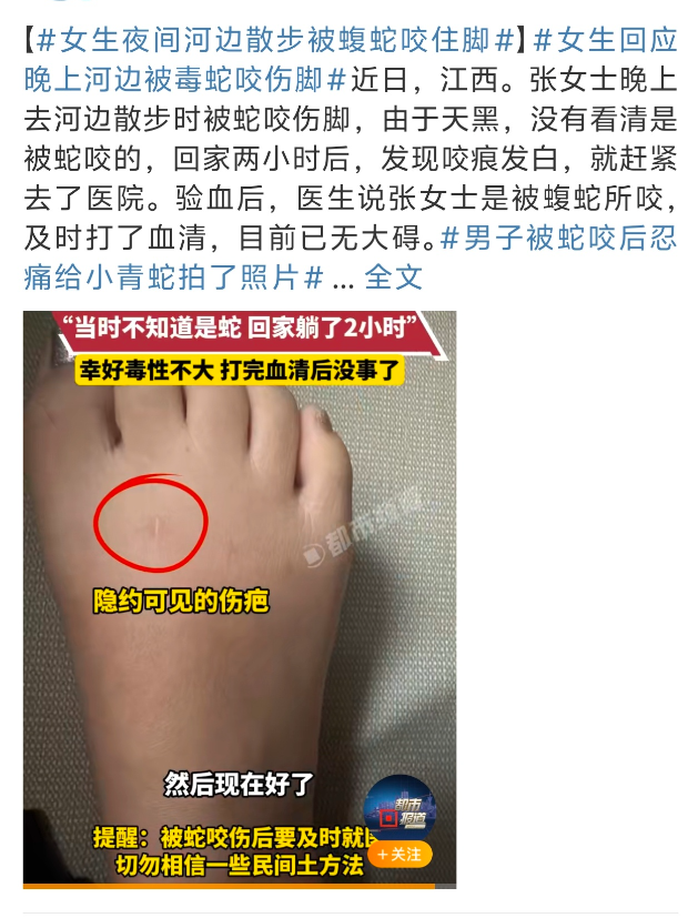 这次三亚蛇咬事件估计把三亚医院
搞得头昏脑涨的应该
这不刚刚江西又有一女子被蛇咬