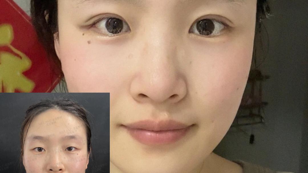 做双眼皮前后变化有多大？真人案例：单眼皮秒变精致电眼！