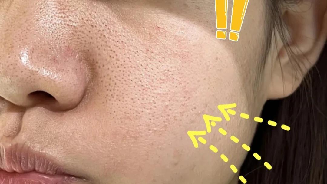 熬夜党必看！毛孔粗大怎么办？改善毛孔粗大的终极指南