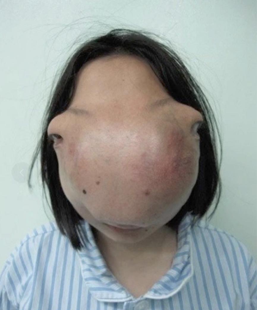 2009年，一名22岁浙江女孩因长了一张怪脸，被迫蒙面生活13年，当她好不容易凑