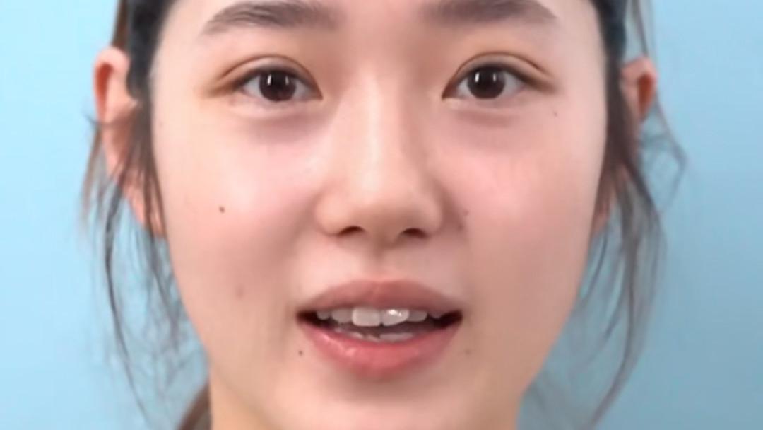 窄双开扇术后效果如何？真人案例：秒变少女感电眼！