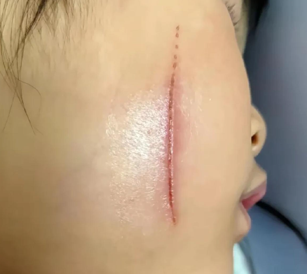 难道年龄真的能成为暴力的“免罪金牌”吗？一名14岁女生被同学用刀具割伤脸部，校服