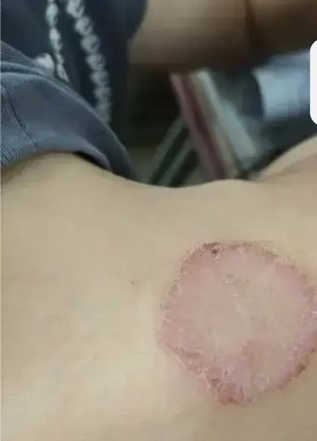 湖南，一名女子总觉得脖子后面非常痒，但是看不见，只能不停地抓。一天，她实在痒得受