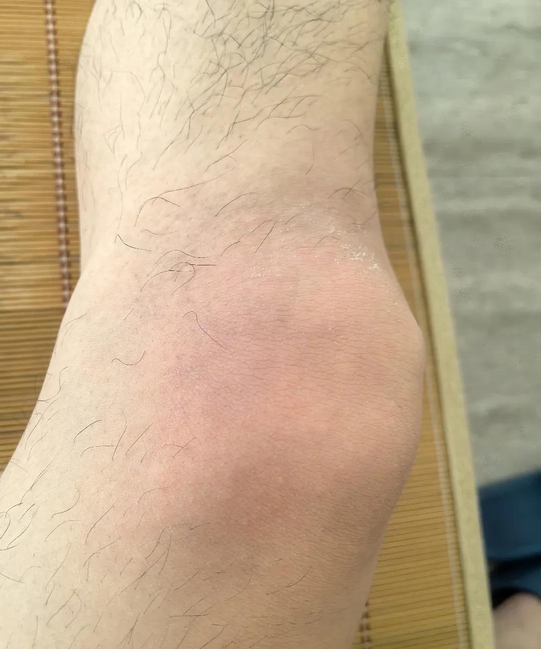 无意间治好了困扰我多年的一片湿疹。
我的左腿膝盖外侧，每年夏天都会红一片，不挠不