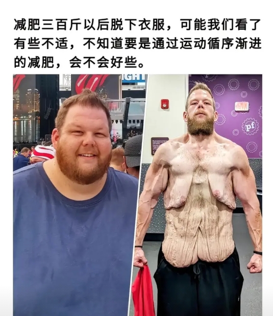 这是抽脂了吗？还是快速减肥？太吓人了...还是管住嘴迈开腿吧。