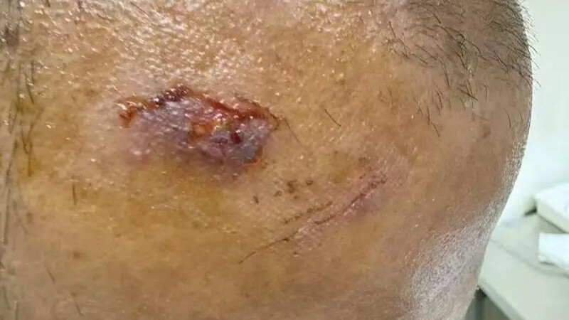 深圳湾护栏脱焊划伤市民头部，城管三天完成修复