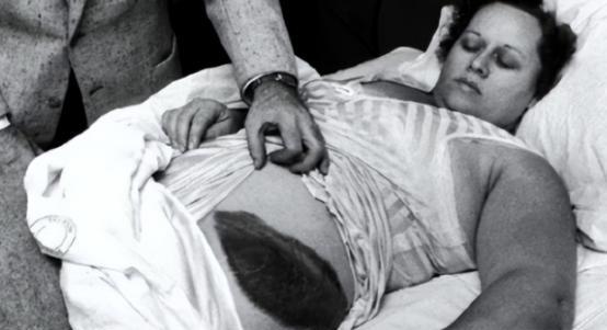 1954年，一个女子在睡觉时突然感到腹部和大腿被什么东西擦过，疼痛让她惊醒。她起