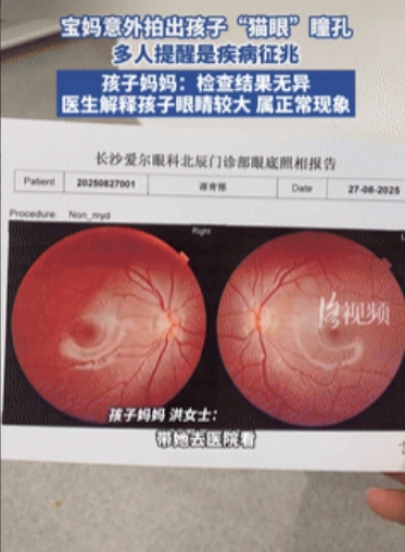 长知识了！”湖南长沙，女子闲着无聊给女儿拍照，不料却看到孩子眼睛发红像“猫眼”，
