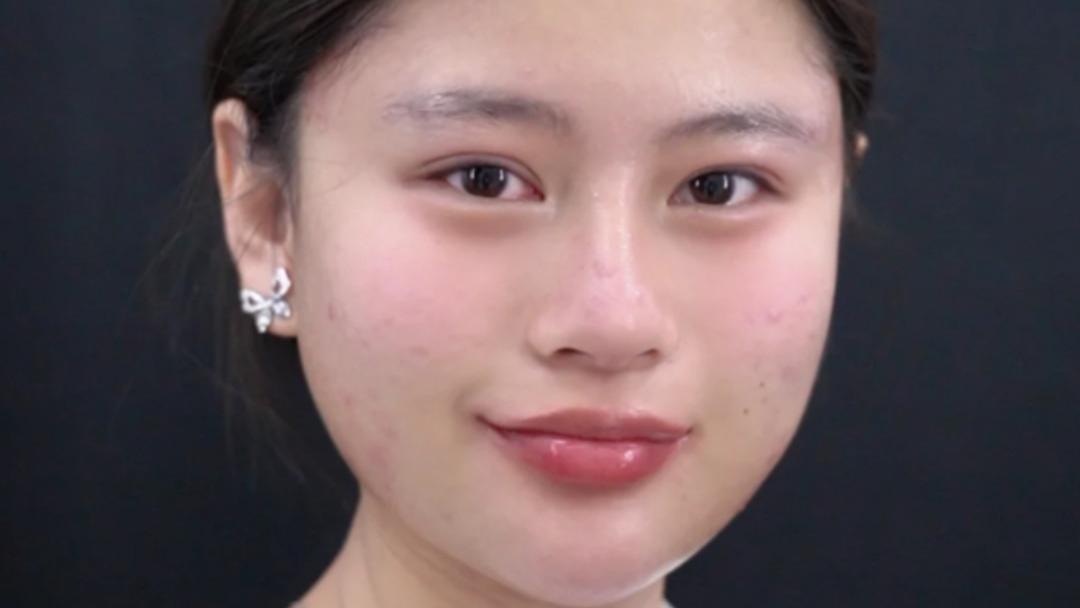 如何科学提升面部立体度？张敬花案例：扁平脸秒变高级脸！