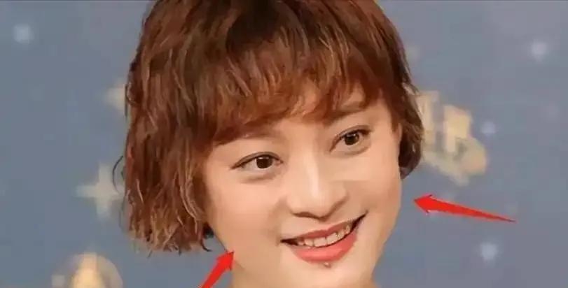 孙俪唇下痣没了！竟是车祸疤痕，新剧转型引期待
一直以为孙俪的唇下痣是天生的标志，