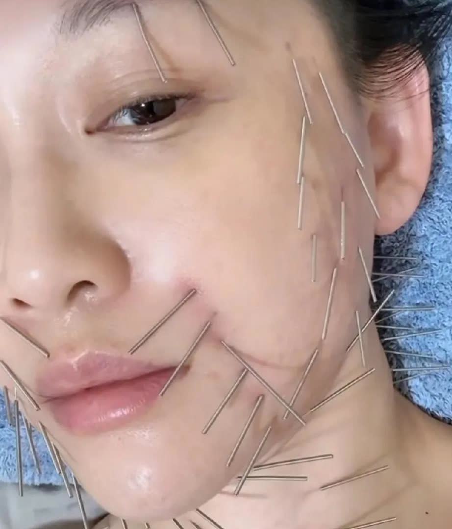 恐怖！陈乔恩针雕全身扎针！肉眼可见的痛感！


今日，陈乔恩在其社交平台分