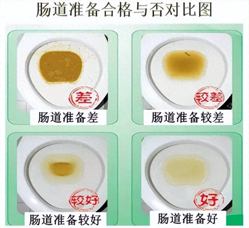 别害羞，聊聊做肠镜前的那件“大事”