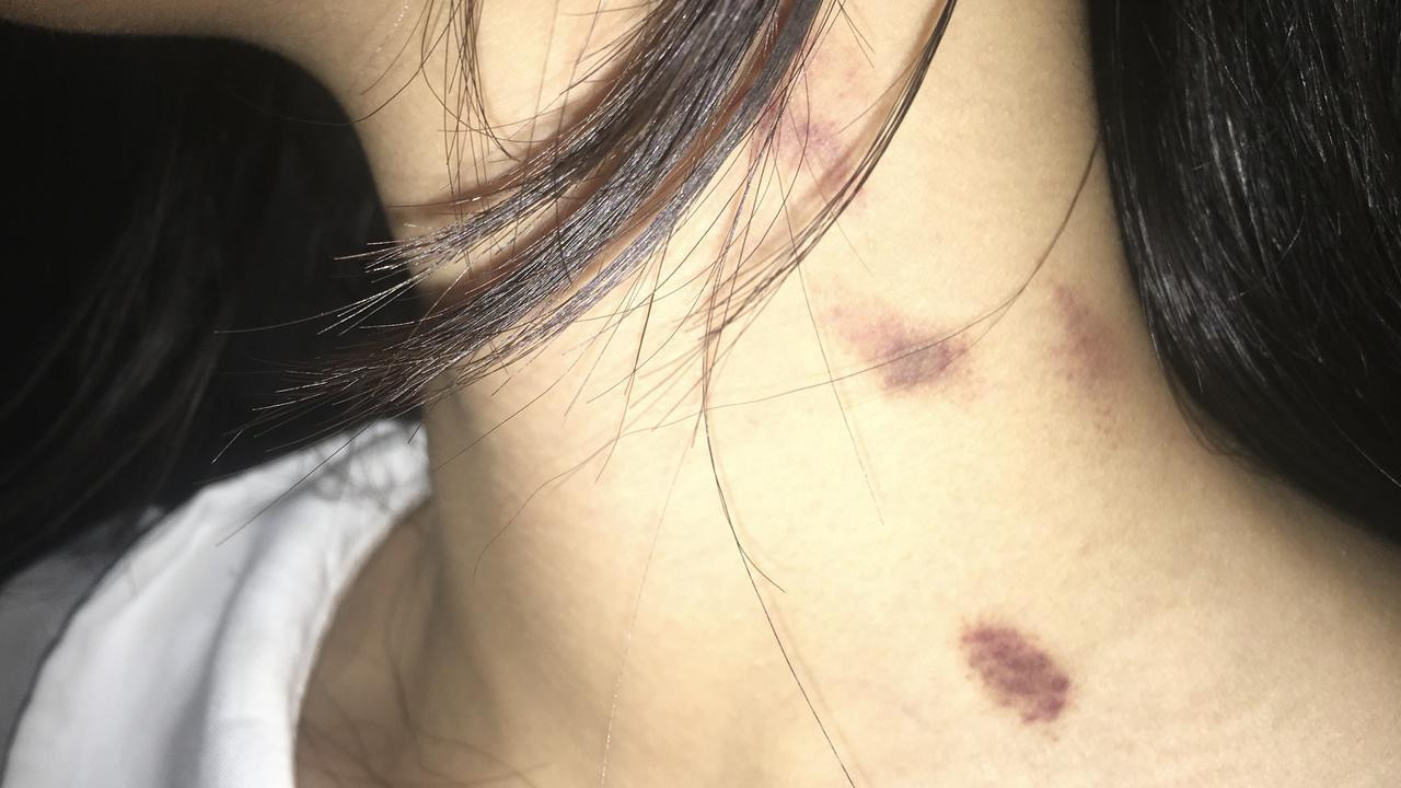 亲吻后，如何快速去除脖子上的草莓印？