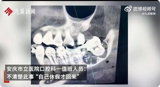 庸医害人啊！
女子去医院拔智齿，医生拔错了，拔成原生牙齿，并且装在女子智齿上。这