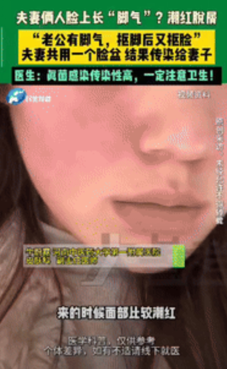 “长知识了！”河南郑州，一男子有脚气，抠完脚后又抠脸，把真菌带到了脸上，因为妻子