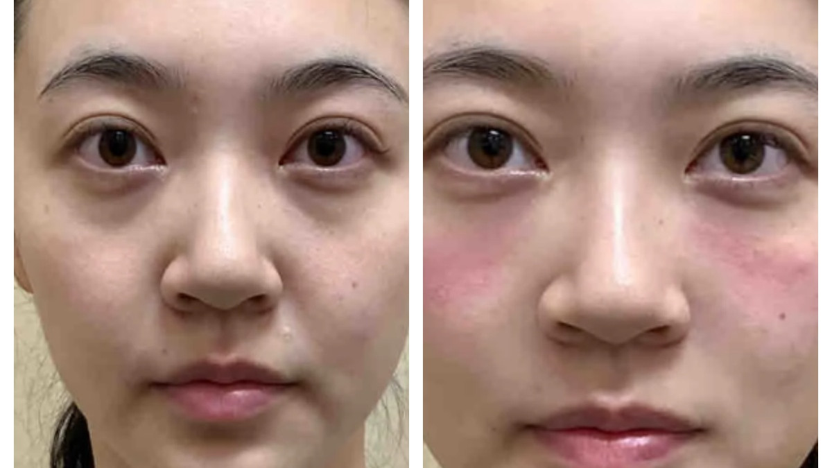 术前VS术后，鼻基底+苹果肌+泪沟三联填充，玻尿酸实现全脸逆袭！