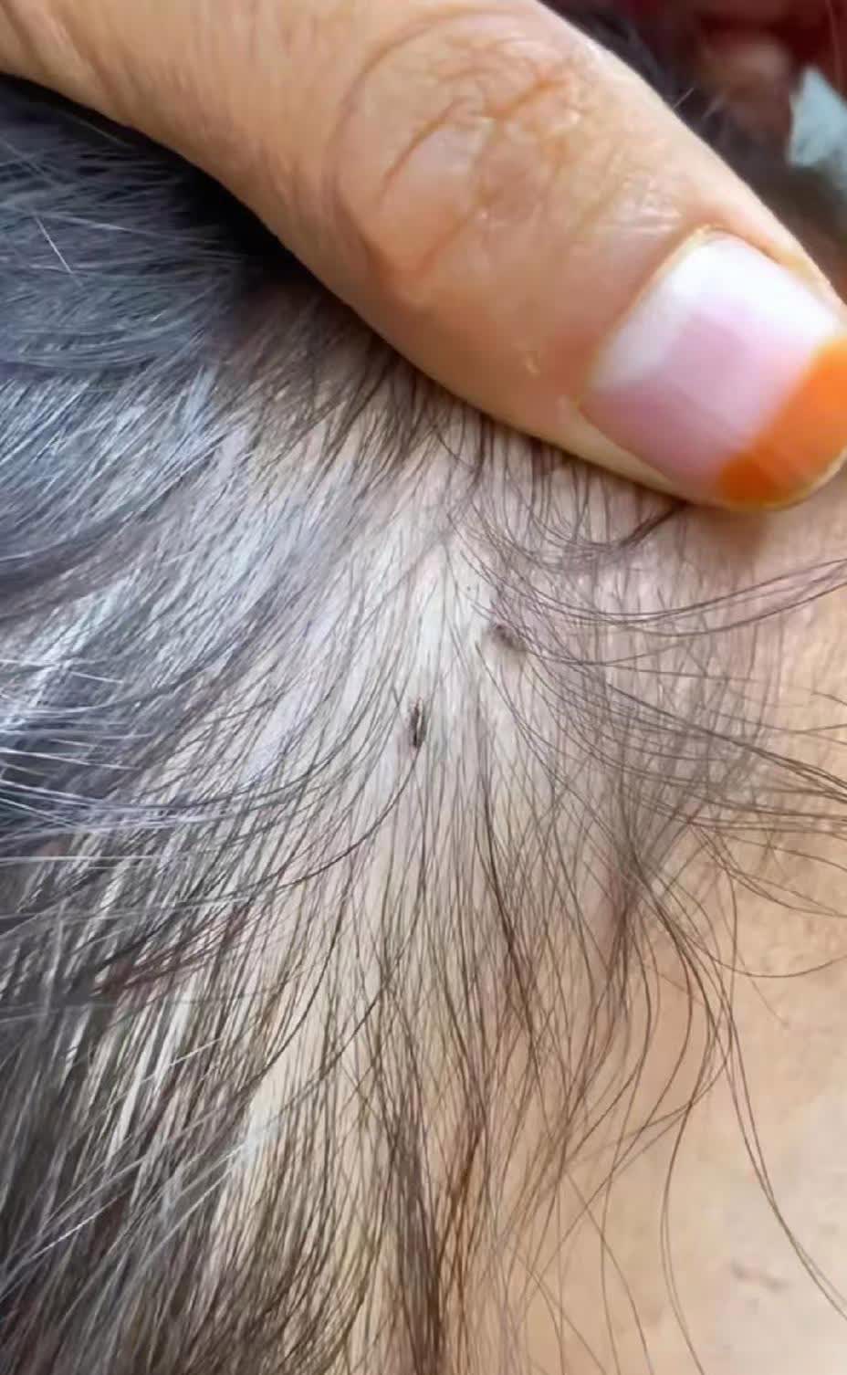 震惊了，这个年代头上还长虱子icon，起初是女儿告诉我同学说发现她头上长有很多白