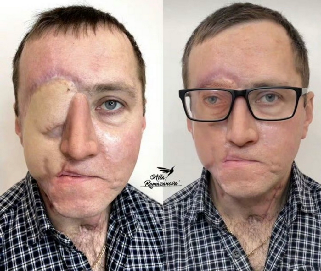 国外一男子因车祸失去一只眼睛，纹身师为其在眼眶处纹制 “新眼睛”，看起来效果挺不