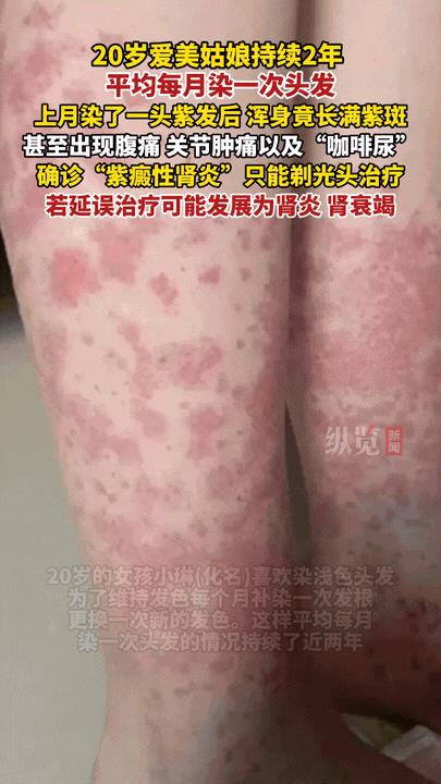 “这就是染头发的后果！”杭州，一个20岁女孩特别爱美，每个月几乎都要染一次头发，