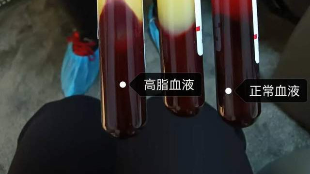 每4人就有1人血脂异常！你的血管还好吗？