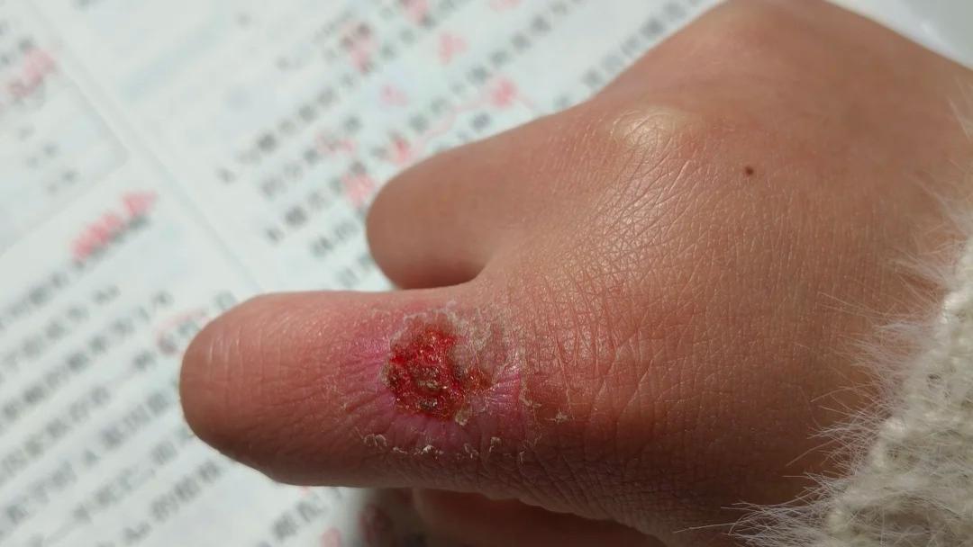 年年冬天犯冻疮，有什么不反复的方法吗？