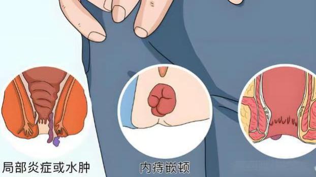 痔疮严重真的会 “爆” 掉吗？医生揭穿真相，这些危害比 “爆” 更可怕！