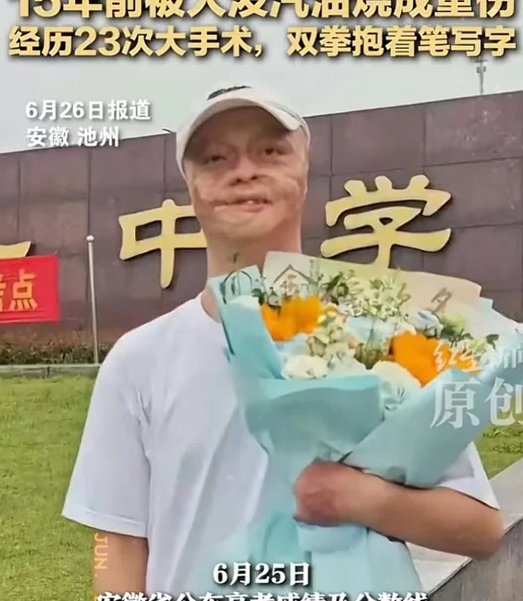 烧伤男孩方益凡高考664分
安徽男孩方益凡6岁是在舅舅家做客，因舅舅与一名男子