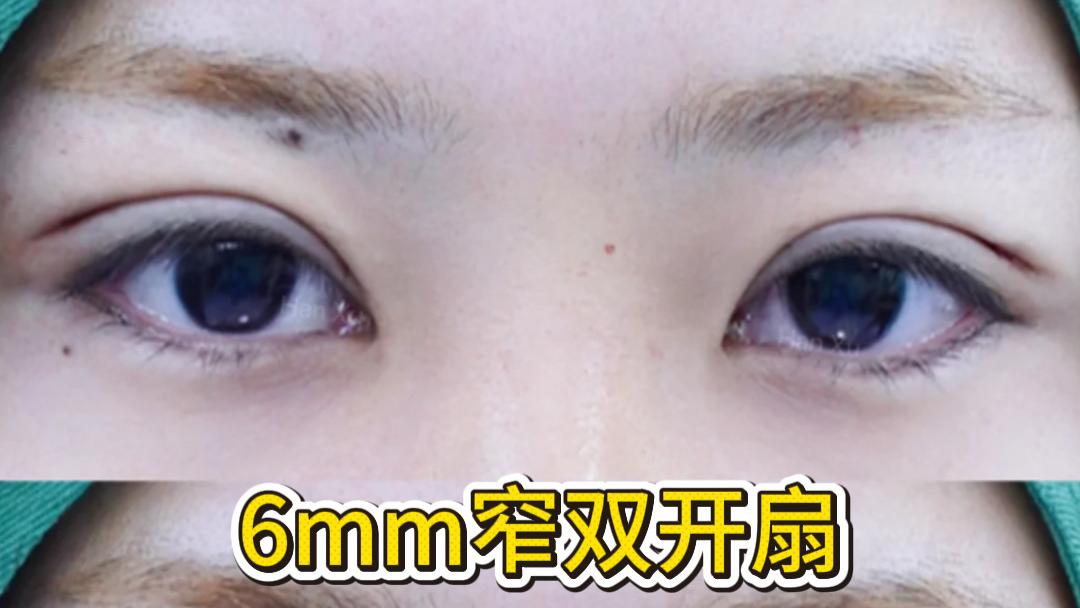 6mm窄双双眼皮效果？真人案例：打造妈生感自然眼！