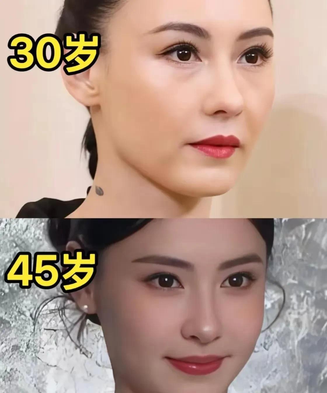 张柏芝这算是微调届“天花板”了吧？
真是妥妥的“逆生长”啊！
面部填充后整张脸都