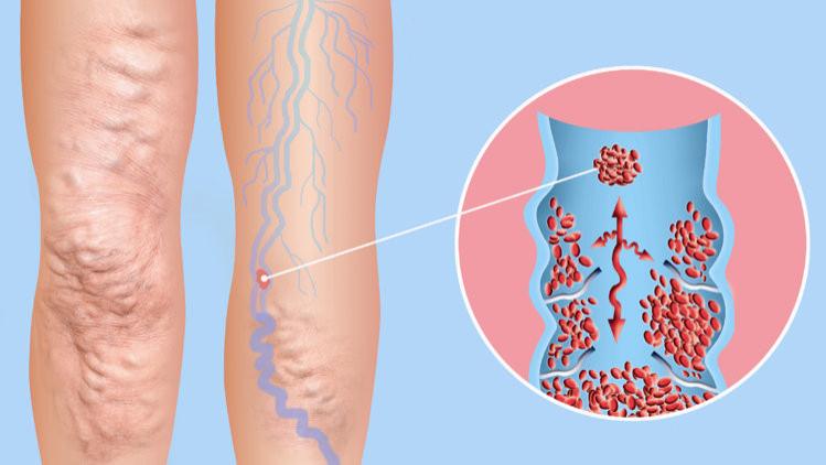 血栓来临，手脚先知？提醒：手脚若出现4个迹象，警惕血栓来袭
