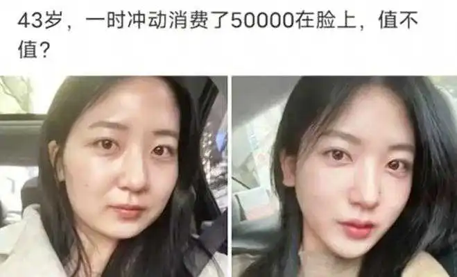 43岁花五万整容，这效果值吗？