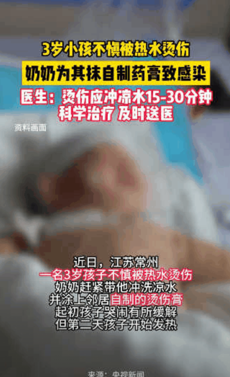 看的气死人！江苏，3岁男童不慎被烫伤，老人非要抹上自制药膏，觉得比去医院管用，结