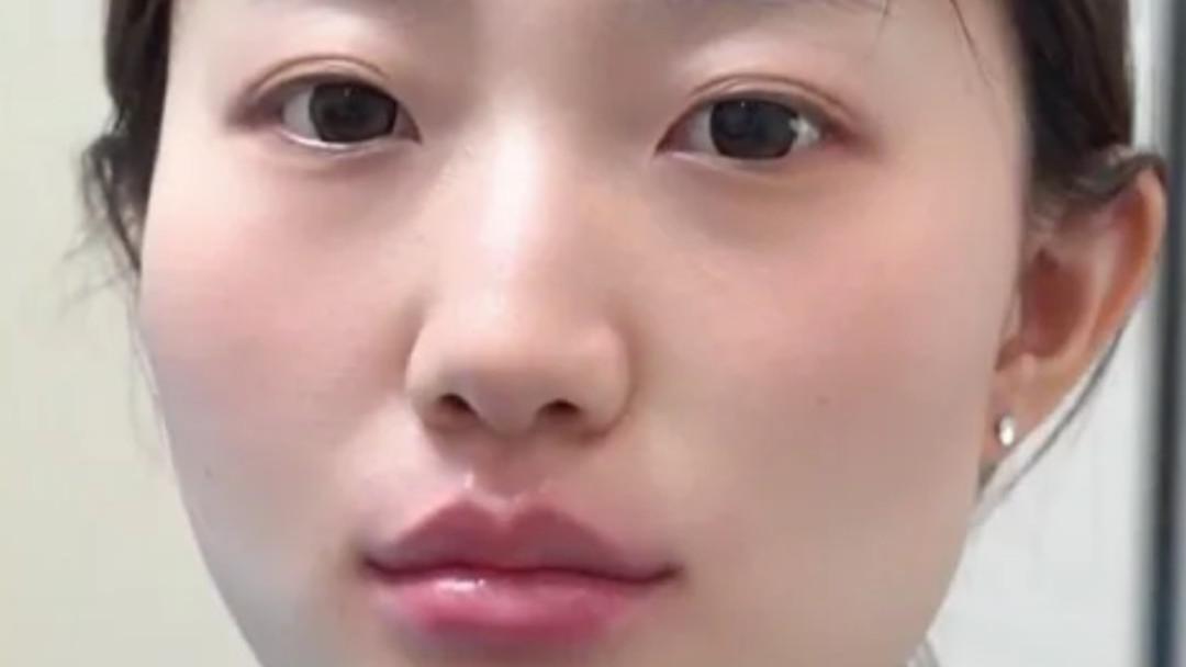 注射唇部效果如何？真人案例：干瘪唇秒变饱满果冻唇！