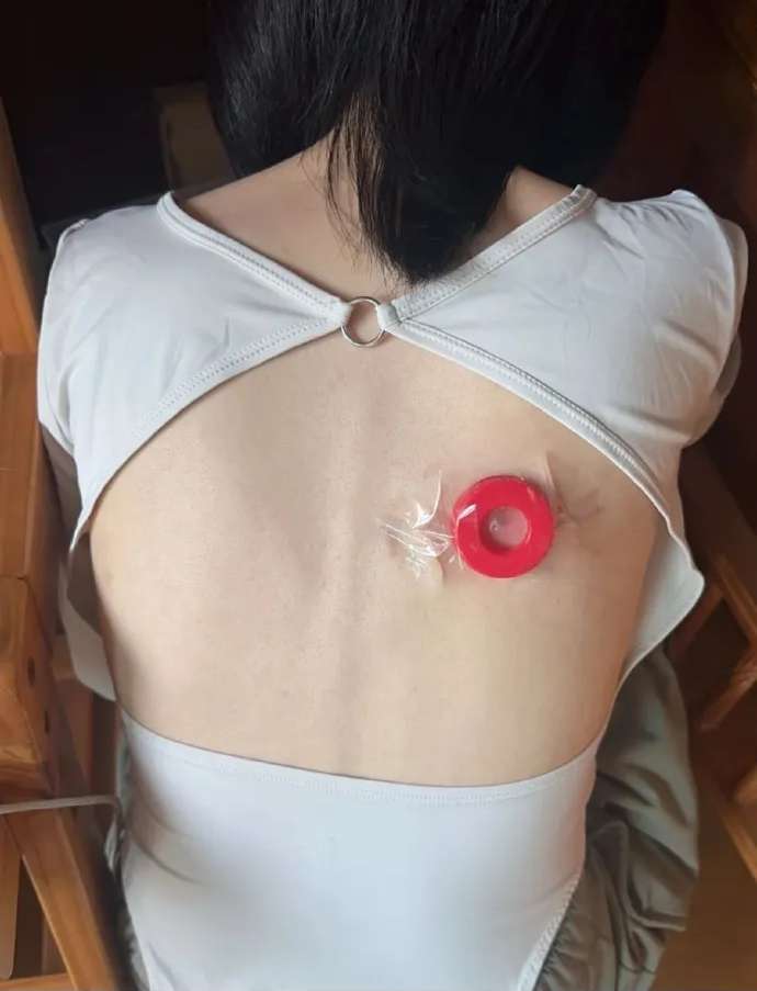 女朋友背上有个火疖子，一碰就疼，没办法只能这样了。