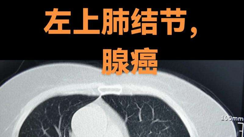 肺结节为什么这么多？和你肠子里的屎拉不干净有关系，从肠道菌群到中医肺与大肠相表里！