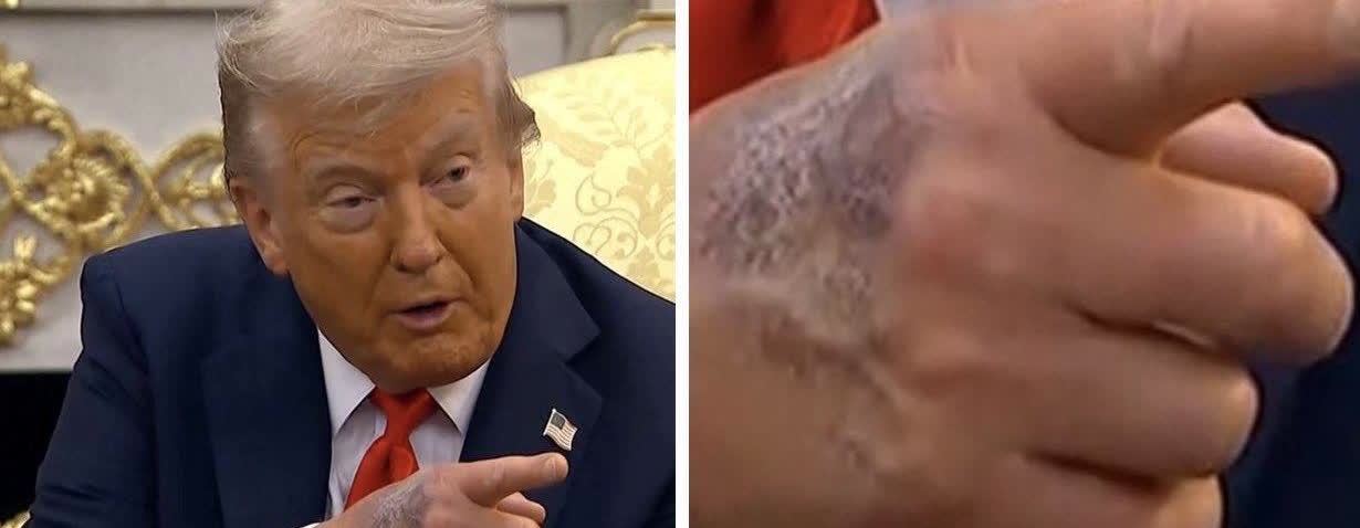 特朗普的手背怎么了？一大片淤青。

白宫将特朗普右手的瘀伤，归咎于频繁握手、
