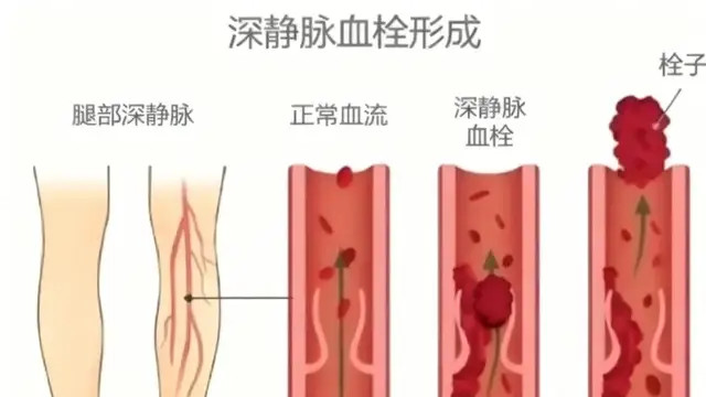 血管里取出的“碎肉”是血栓？身体这4个信号，可能早就提醒你了