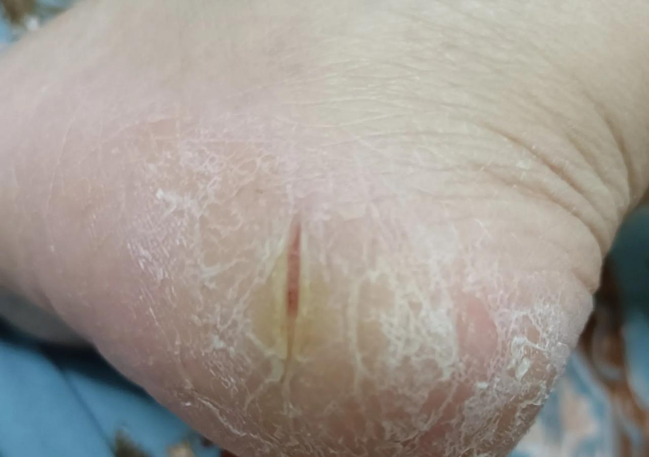 回家发现妈妈的脚长这样了，走路脚很痛真的是太难了，现在天又不是很冷，脚却裂开了，