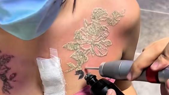 女子洗掉胸前纹身准备嫁人，再疼再难也咬牙坚持：不能影响要彩礼