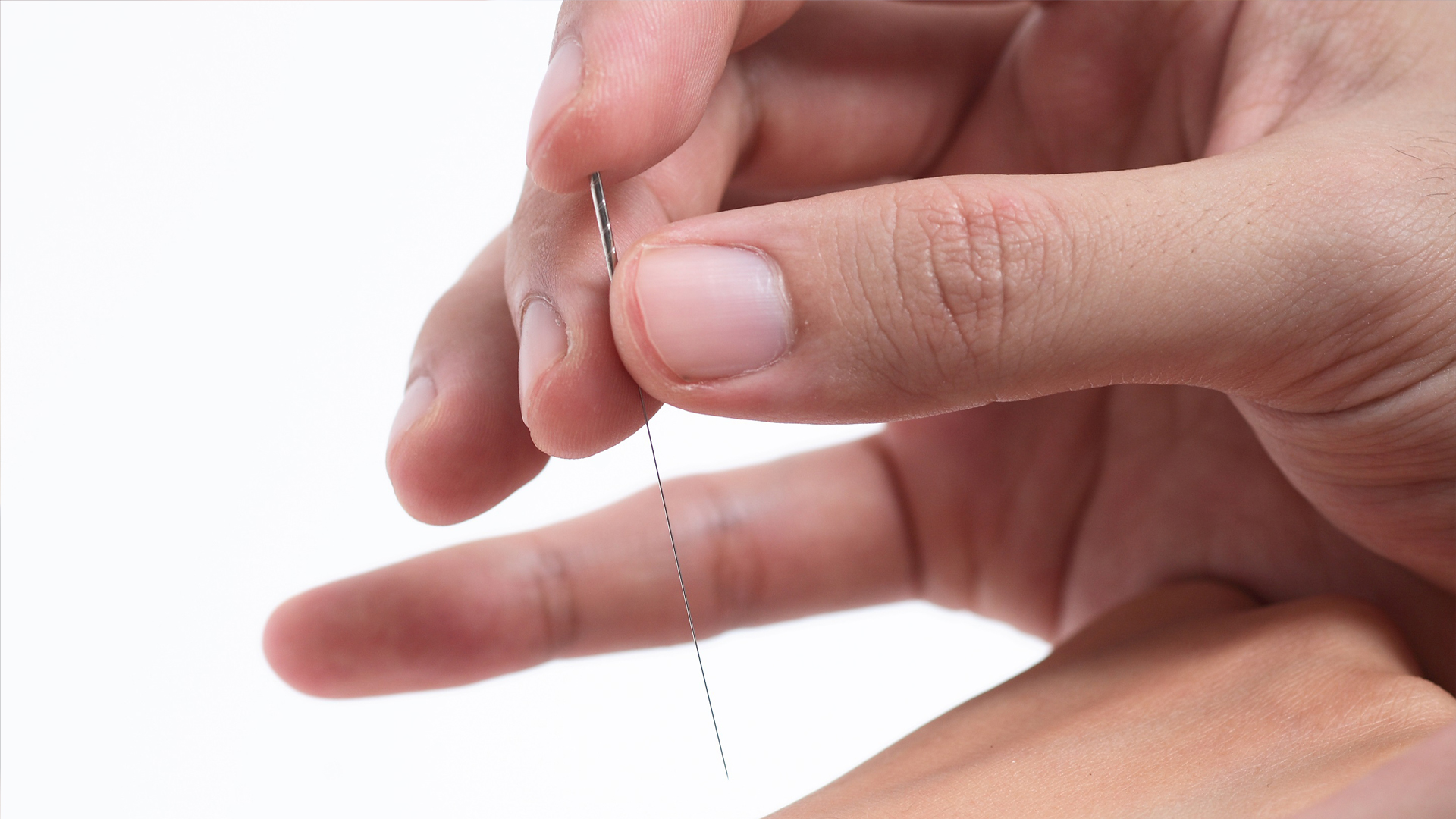 粟龙教授针刺维胞穴一次治愈严重子宫脱垂案