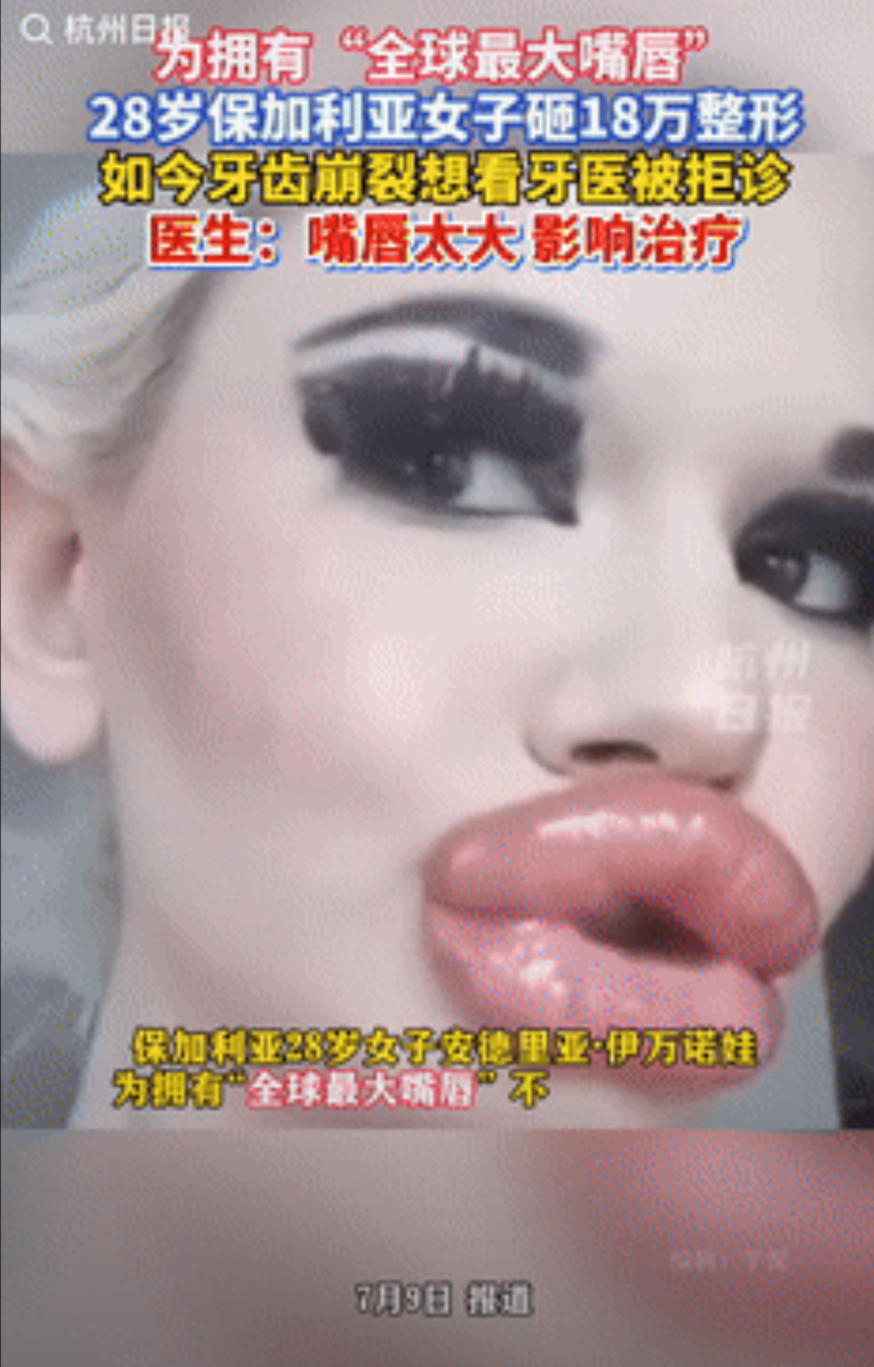 “逆天了！”保加利亚， 一28岁女子花了将近18万人民币，将嘴唇变得像两根香肠，