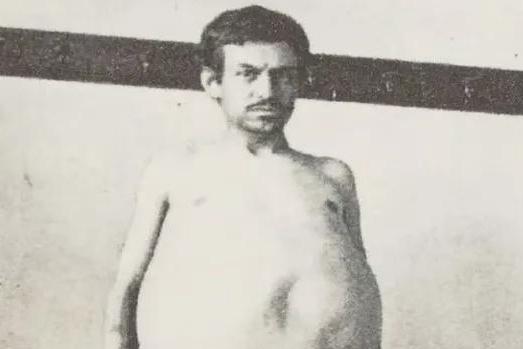 “他是被屎憋死的。”1940年，一美国男人因为三年没有排泄，最终不幸去世，医生检