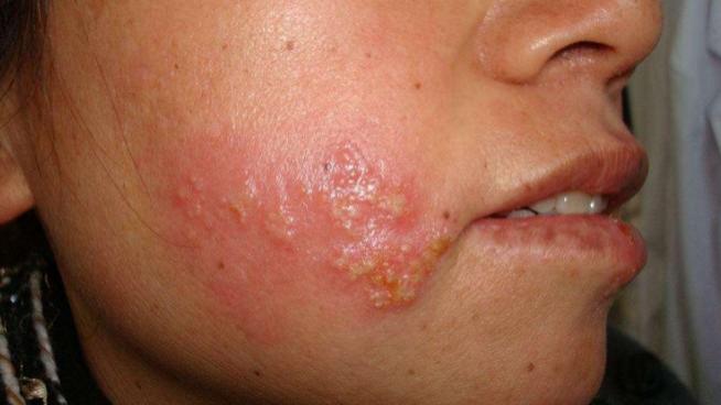 疱疹病毒潜伏在正气不足之前