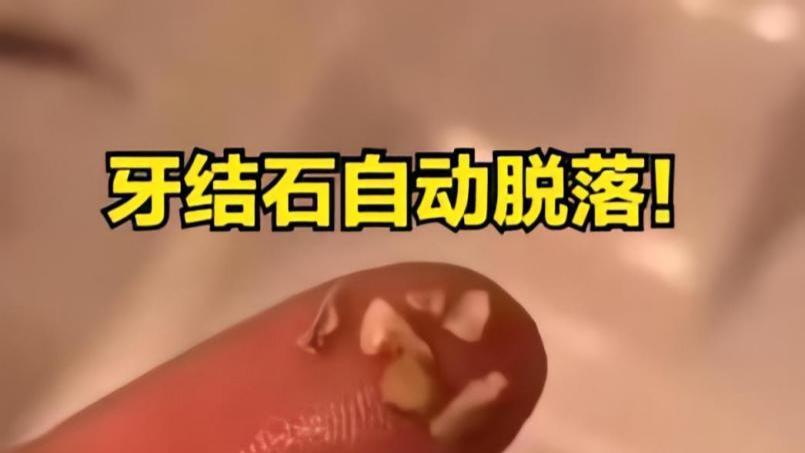 牙结石堆积如山又臭又硬？教你一个自用妙招，牙结石自动脱落！